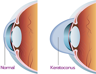 Κερατόκωνος 1 keratoconus
