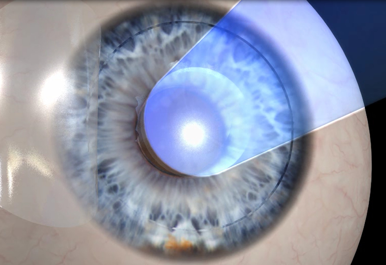 refractive 30-2