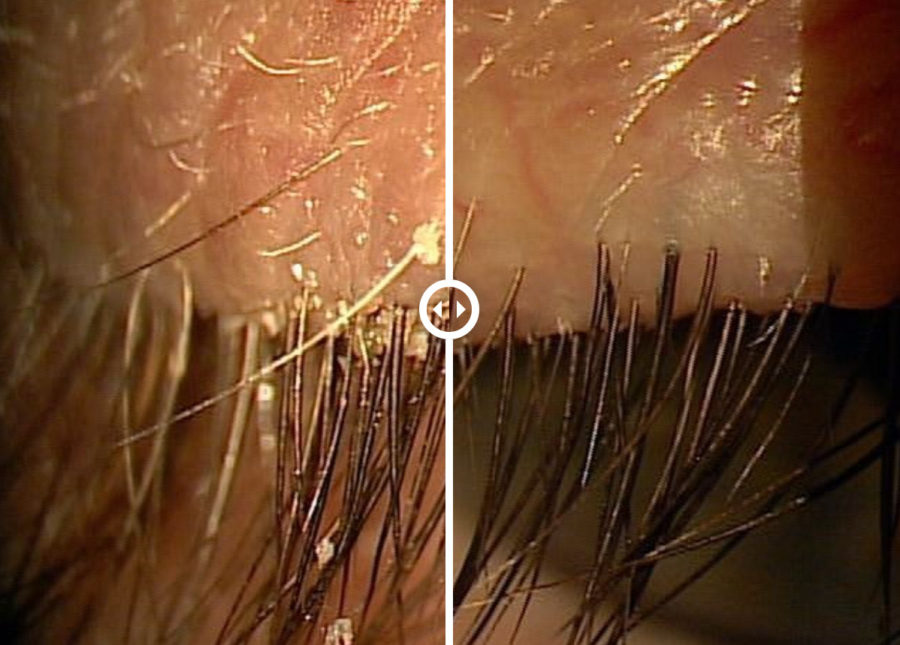dry eye 5