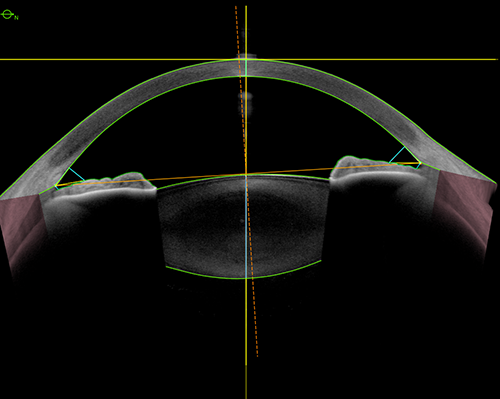 Το Epithelial Thickness Module του συστήματος Heidelberg Anterion στο Ινστιτούτο Ophthalmica 9 anterion 2