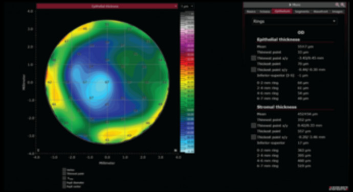 Το Epithelial Thickness Module του συστήματος Heidelberg Anterion στο Ινστιτούτο Ophthalmica 7 epi 1