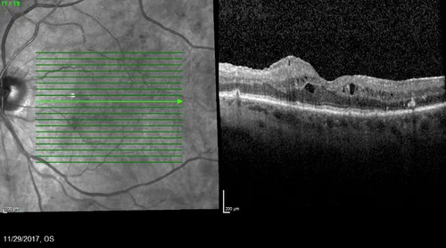 20211220 diabetic macular edema
