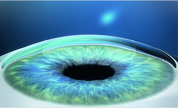 SMILE brochure ZEISS Meditec 11