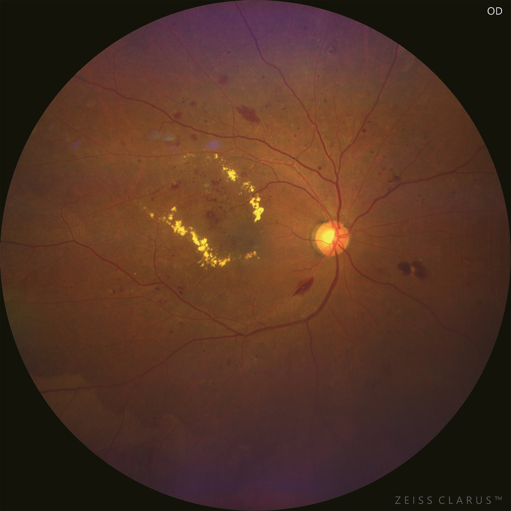 diabetic retinopathy magnified color 1