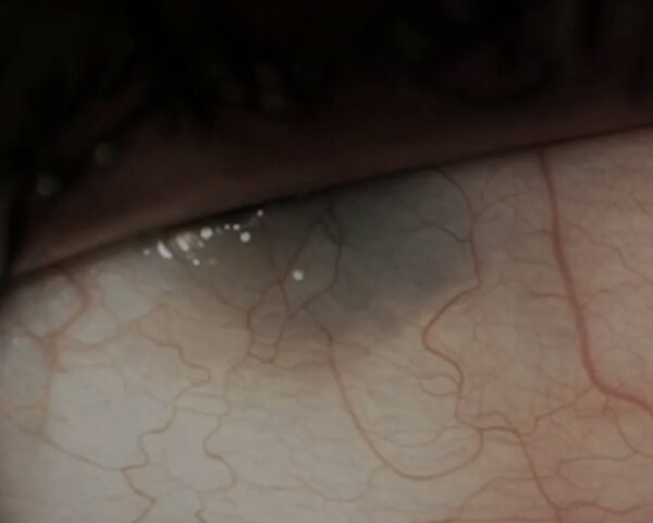 Case of the month | Feb 2026 | A 42-year-old man presented with pain in his right eye 6 months after corneal graft surgery 8 Fig. 2 HQ